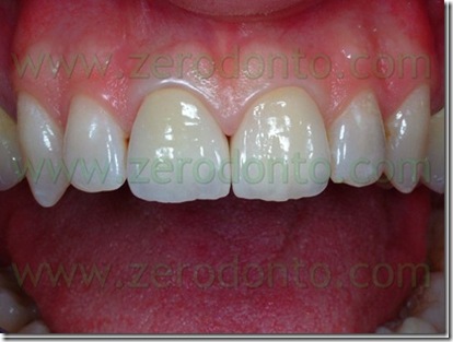 DSCF3451dente21inceramicadopo_thumb2[3]