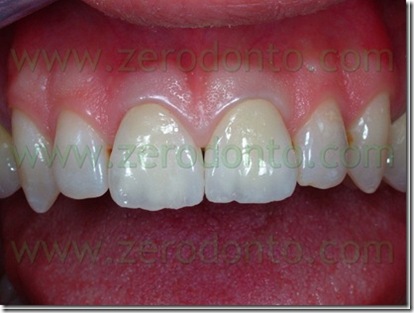 dente11inceramicabis_thumb2