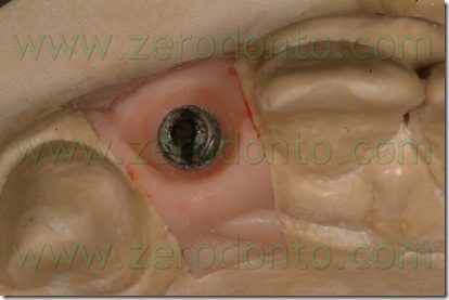 analogo impianto straumann bone level