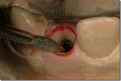 tragitto transmucoso