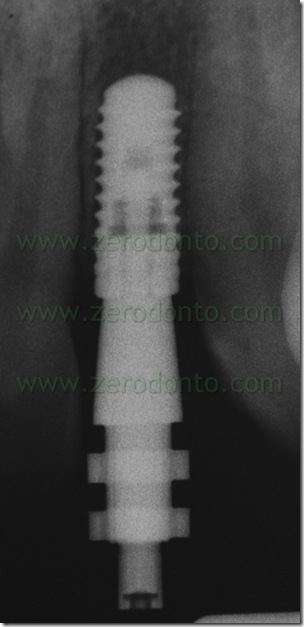 analogo impronta straumann bone level