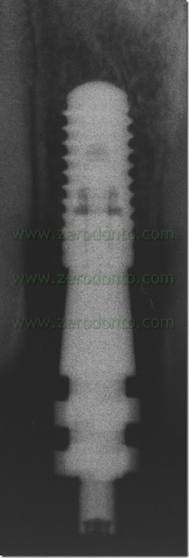 analogo impronta bone level