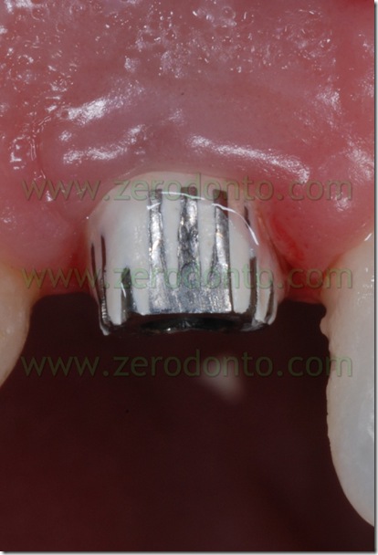 moncone implantare provvisorio