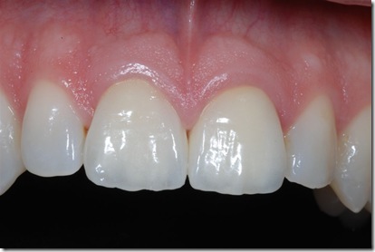 controllo a 5 anni protesi in ceramica integrale