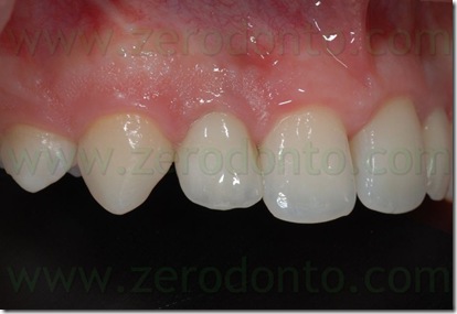 ceramica integrale corona impianto
