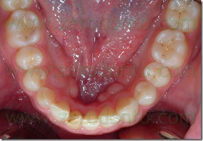 occlusale inferiore
