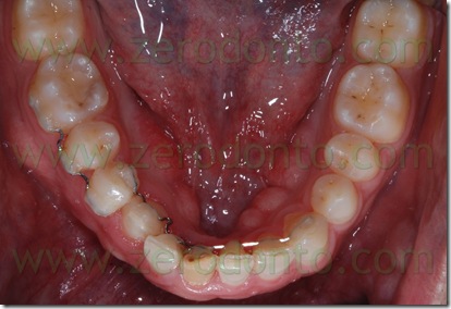 retainer attivo