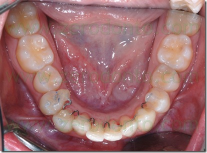 allineamento dentario