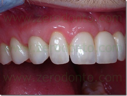 corone zirconio ceramica