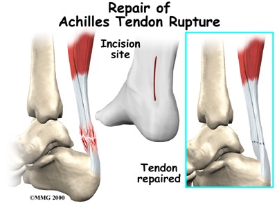 [foot_achilles_tendon_treatment02[4].jpg]
