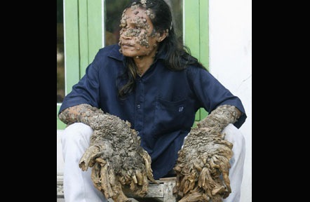 IndonesianTreeMan2
