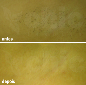 Untitled 2 Depilação definitiva em casa é possível?