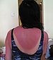 [75px-Sunburn2[1][3].jpg]