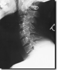 Normal cervical Radiograph