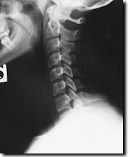 X-ray image of neck injured in an auto crash