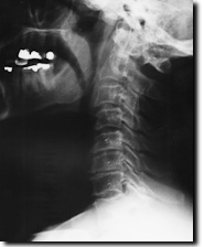 Radiograph of an injured neck from an auto crash