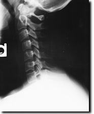 Neck x-ray showing auto injuries where the cervical curve has been reversed