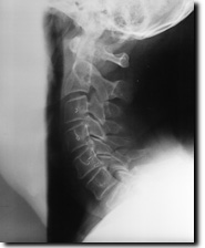 Normal cervical radiograph