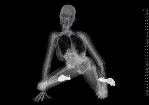Frank picture X-ray picture
