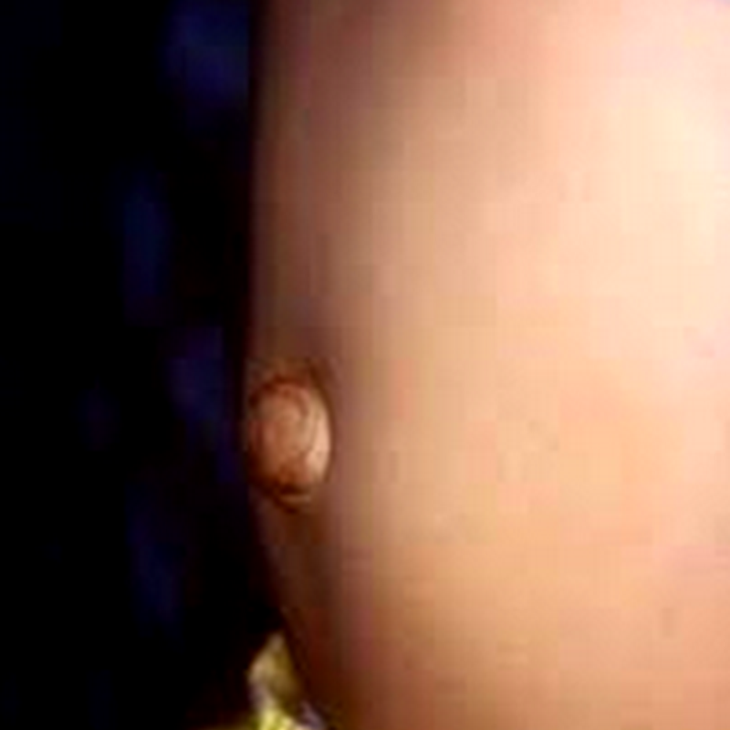 HERNIA Part 01