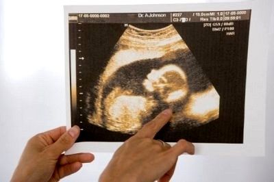 3D Fetal Ultrasound Image