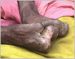 [leprosy[2].jpg]