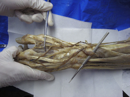 rupture extensor pollicis longus tendon wristicd9