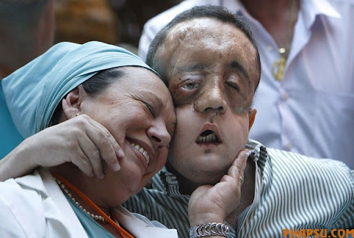 epa02142658 A nurse (L) laughs next to Rafael (R), the first face transplant patient in Andalusia during a press conference they held after he was discharged from the Virgen del Rocio hospital in Seville, southern Spain, 04 May 2010. This is the second facial tissue transplant done in Spain and the ninth worldwide. The surgery was carried out by over 100 doctors in January 2010 and lasted 30 hours. Dr. Gomez Cia stated the surgery was 'a success' and was the only solution for the Neurofibromatosis type one Rafael suffered.  EPA/EDUARDO ABAD