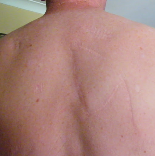 Z-shaped scar in the middle of my back is a result of the flap repair used for reconstructive surgery