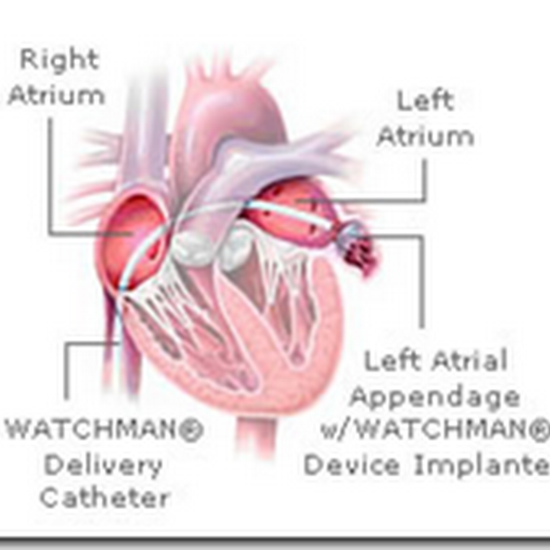 Atrial  Fibrillation – What will be the future standard of care, Warfarin or the Watchman Device?