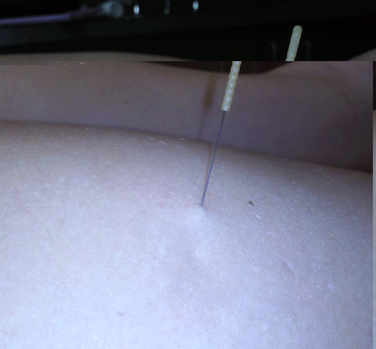 needle1