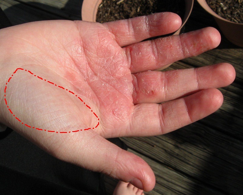 [Hand Eczema - Hand Dermatitis[4].jpg]