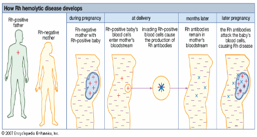 erythroblastosis-fetalis