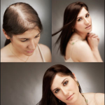 women hair loss