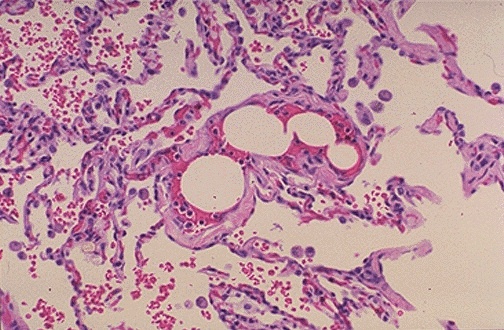 embolism