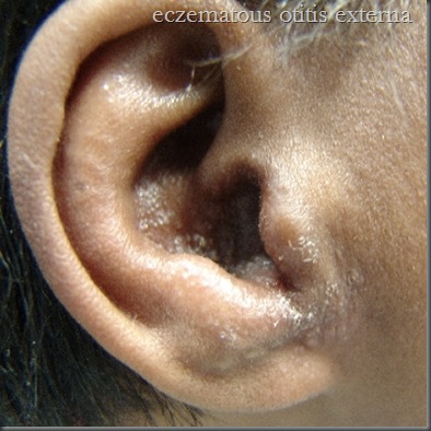 eczematous otitis externa