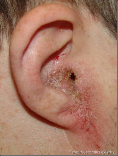 Meatoplasty Ear