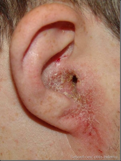 Seborrhoeic otitis externa