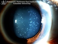 blue dot cataract