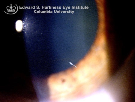 Corneal Blisters
