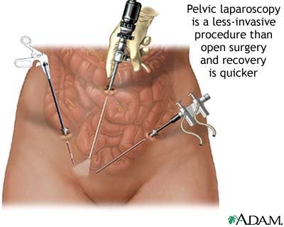 [laparoscopy[8].jpg]