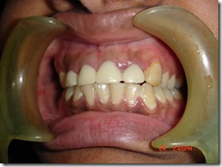 Temporary Crowns In Place