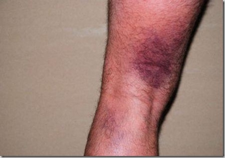 lab_image_hamstrung