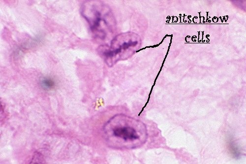 [anitschkow cells[9].jpg]