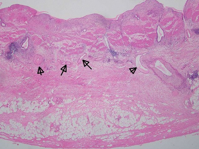 [rokitansky aschoff sinuses[6].jpg]