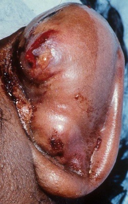 [hematoma[5].jpg]