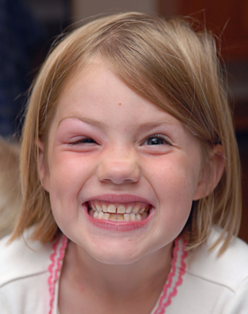 [isabelmosquitobiteface[1].jpg]