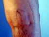 Flebologo Tratamiento Varices Unico En Caracas 