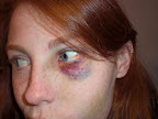 An Accidental Experiment black%20eye An Accidental Experiment