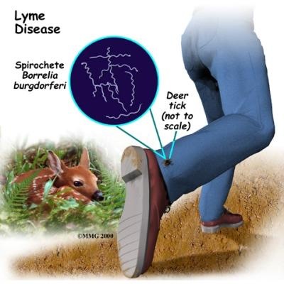 [lyme disease[3].jpg]
